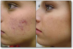 Acné et cicatrices d'acné